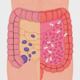 Illustration showing the impact of antibiotics on the colonic mucus barrier